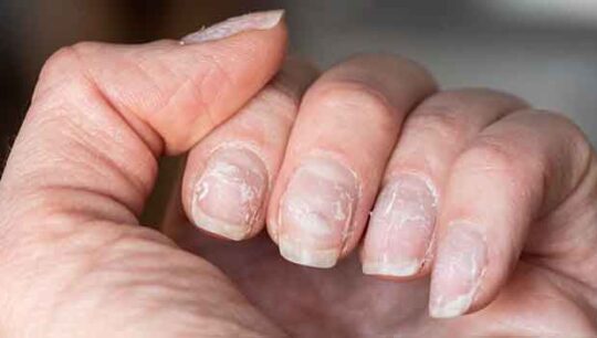 Why are nails flaking or flaking?