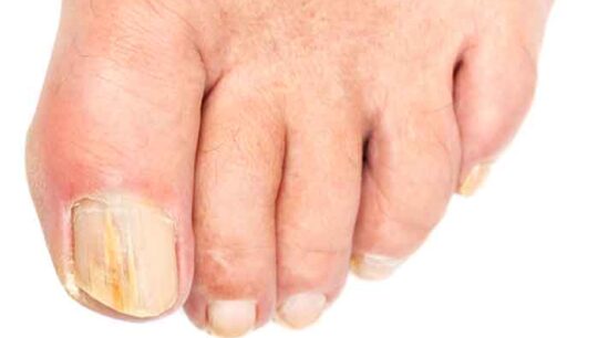 Calcareous nails: what is the cause and how to remedy this problem?