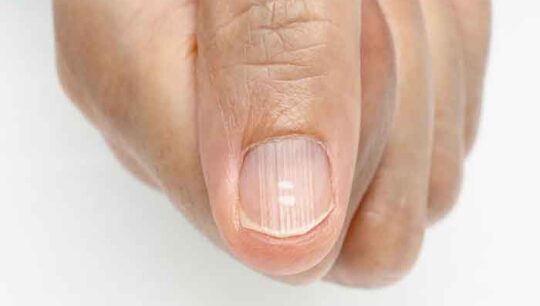 Ridged nail: causes and how to react?