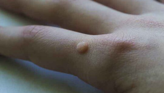 Wart on the hand: causes and treatments