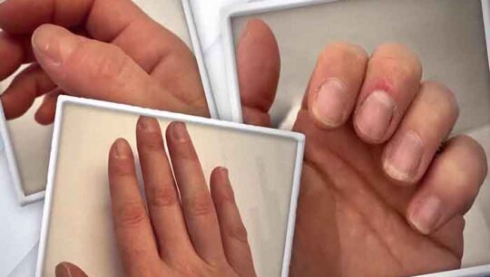 How to get rid of white spots on your nails?